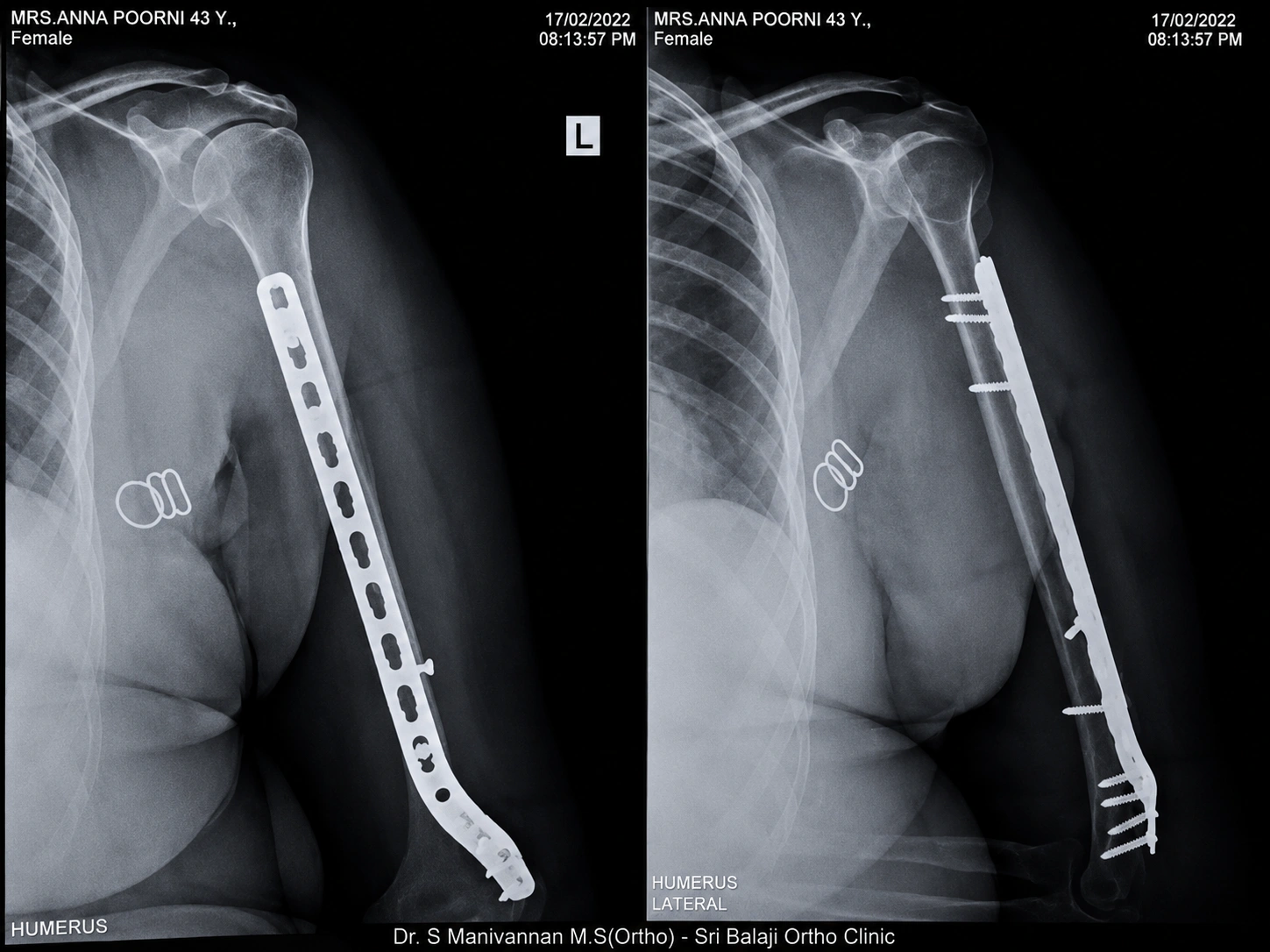 Anatomical Reconstruction After Surgery